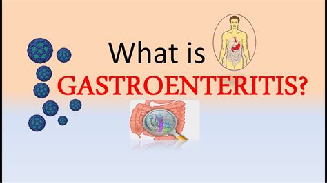 gastroenteritis due to norovirus icd 10